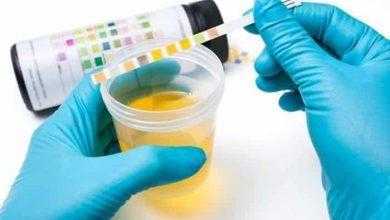 تحليل البول - Urinalysis