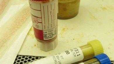 تحليل البراز - Stool Analysis