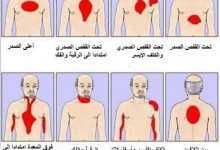 الأماكن المختلفة لألم الذبحة الصدرية Angina Pectoris