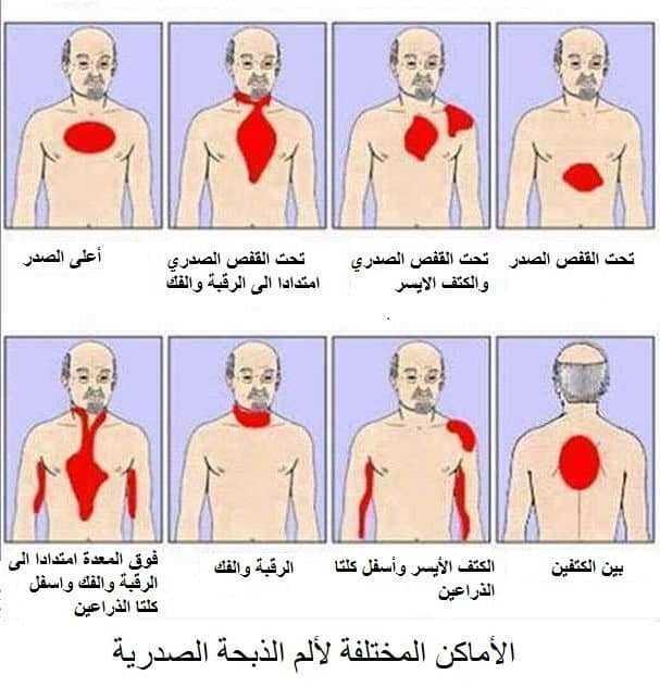 الأماكن المختلفة لألم الذبحة الصدرية Angina Pectoris