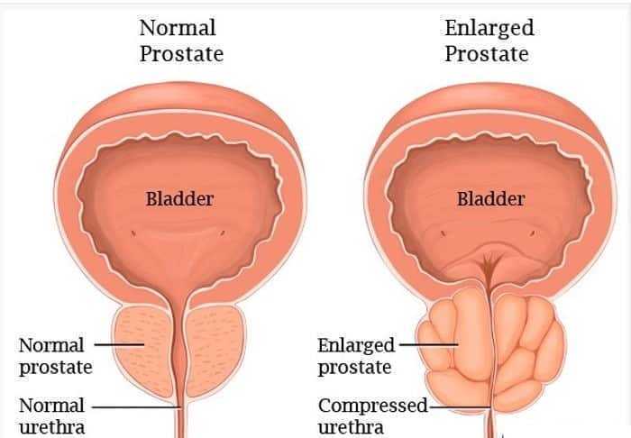 تقنية جديدة تعتمد على النانوتكنولوجي لتشخيص سرطان البروستاتا تقنية جديدة تعتمد على النانوتكنولوجي لتشخيص سرطان البروستاتا