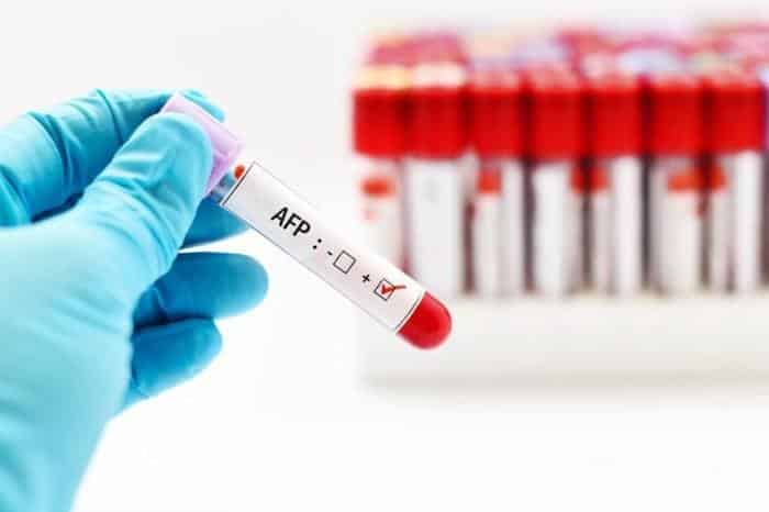 تحليل الألفا فيتو بروتين–Alpha Feto-protein in Blood تحليل الألفا فيتو بروتين–Alpha Feto-protein in Blood