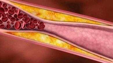 تحليل الدهون والكوليسترول- Lipid profile