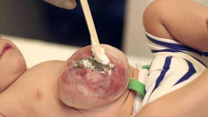 الفتق السري الولادي الفتق السري الولادي