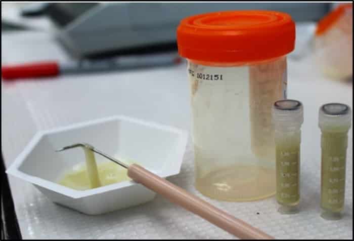 تحليل البصاق – Sputum Analysis تحليل البصاق – Sputum Analysis