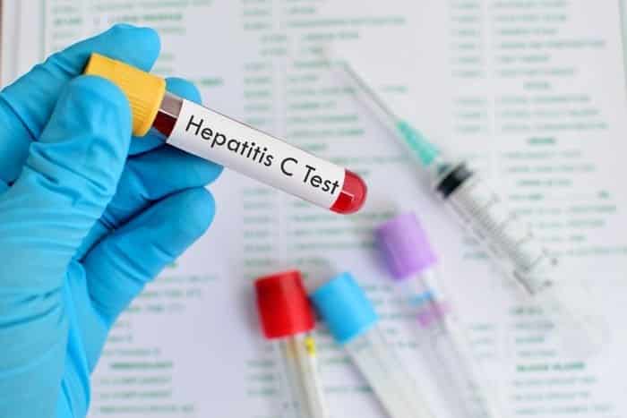 تحليل التهاب الكبد الوبائي (ج) سي - Hepatitis C Virus Test تحليل التهاب الكبد الوبائي (ج) سي - Hepatitis C Virus Test