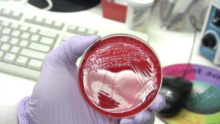 زراعة البصاق (البلغم) – Sputum Culture زراعة البصاق (البلغم) – Sputum Culture