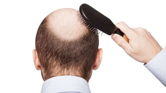 في خطوة قد تقضي على الصلع نهائيا..اكتشاف البروتين المسئول عن نمو الشعر