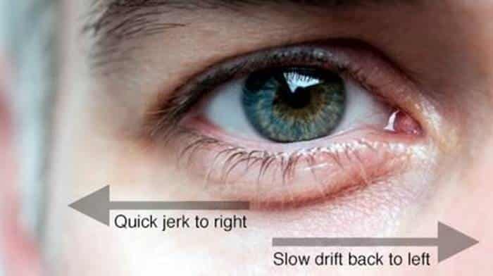 نجاح زراعة مغناطيس للتحكم في حركات العين اللإرادية