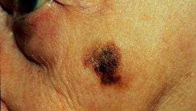 المصابون بمرض باركنسون أكثر عرضة لحدوث سرطان الجلد بنسبة تصل 4 أضعاف
