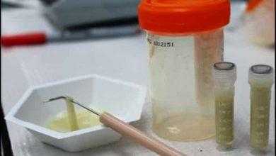 تحليل البصاق – Sputum Analysis