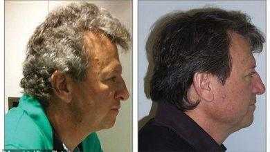 دراسة: أدوية جديدة للسرطان تحول الشعر الأبيض للبني ولا تسبب تساقط الشعر