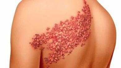 دراسة: الحزام الناري يرفع من خطر الإصابة بالسكتات الدماغية بنسبة 35 %