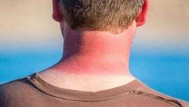 دراسة: فيتامين (د) يساهم في علاج حروق الشمس