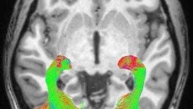 قبل 10 أعوام من حدوثه.. تغييرات بصرية تساعد في تشخيص مرض الشلل الرعاش