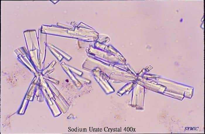 تحليل الصوديوم (Na) في البول تحليل الصوديوم (Na) في البول