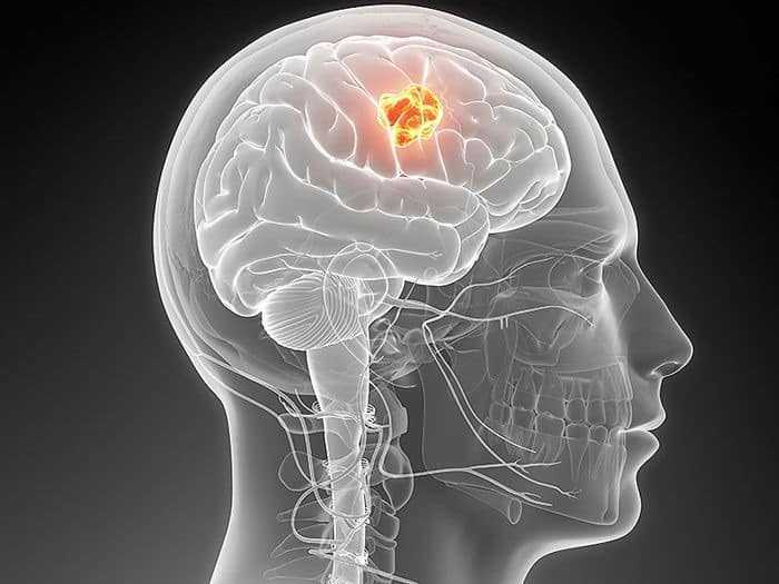 دراسة تثبيط نمو أورام الدماغ الدبقية glioblastoma عن طريق تعطيل أحد البروتينات دراسة تثبيط نمو أورام الدماغ الدبقية glioblastoma عن طريق تعطيل أحد البروتينات
