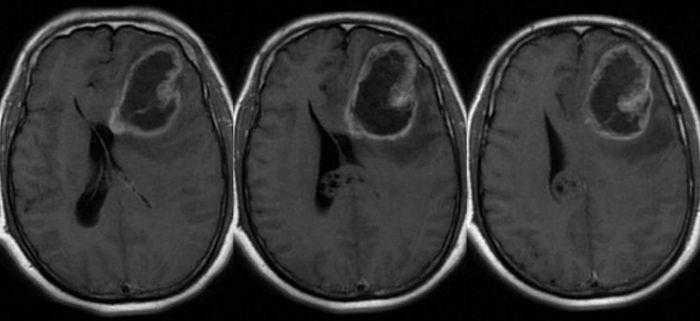دراسة تشير إلى إمكانية استخدام فيروس زيكا لعلاج سرطانات الدماغ القاتلة دراسة تشير إلى إمكانية استخدام فيروس زيكا لعلاج سرطانات الدماغ القاتلة