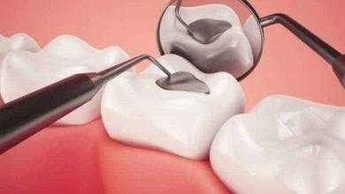 الحشو باستخدام الخلايا الجذعية قد يُمكن الأسنان من الاستشفاء ذاتيا