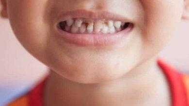 تسوس الأسنان .. مرض موروث أم مكتسب؟