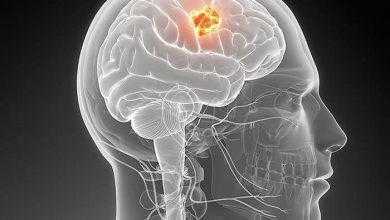 دراسة: تثبيط نمو أورام الدماغ الدبقية "glioblastoma" عن طريق تعطيل أحد البروتينات
