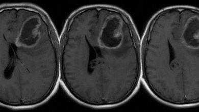 دراسة تشير إلى إمكانية استخدام فيروس زيكا لعلاج سرطانات الدماغ القاتلة