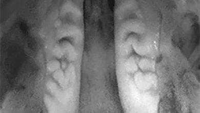 علاج جديد لمشكلة الحنك المشقوق للأجنة داخل الرحم