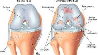 هل ممارسة الرياضة تؤذي المفاصل؟