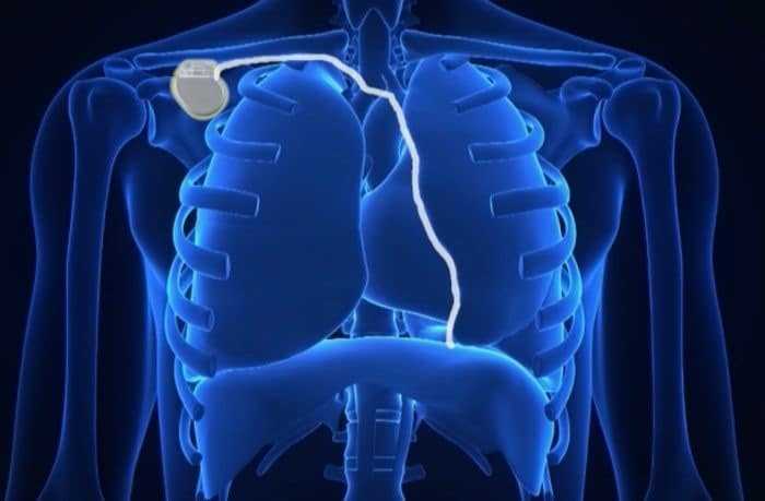 الغذاء والدواء توافق على جهاز جديد لعلاج انقطاع النفس النومي sleep apnea الغذاء والدواء توافق على جهاز جديد لعلاج انقطاع النفس النومي sleep apnea