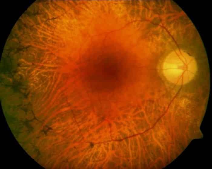 باحثون يتوصلون إلى طريقة لعلاج حالات العمى المستعصية