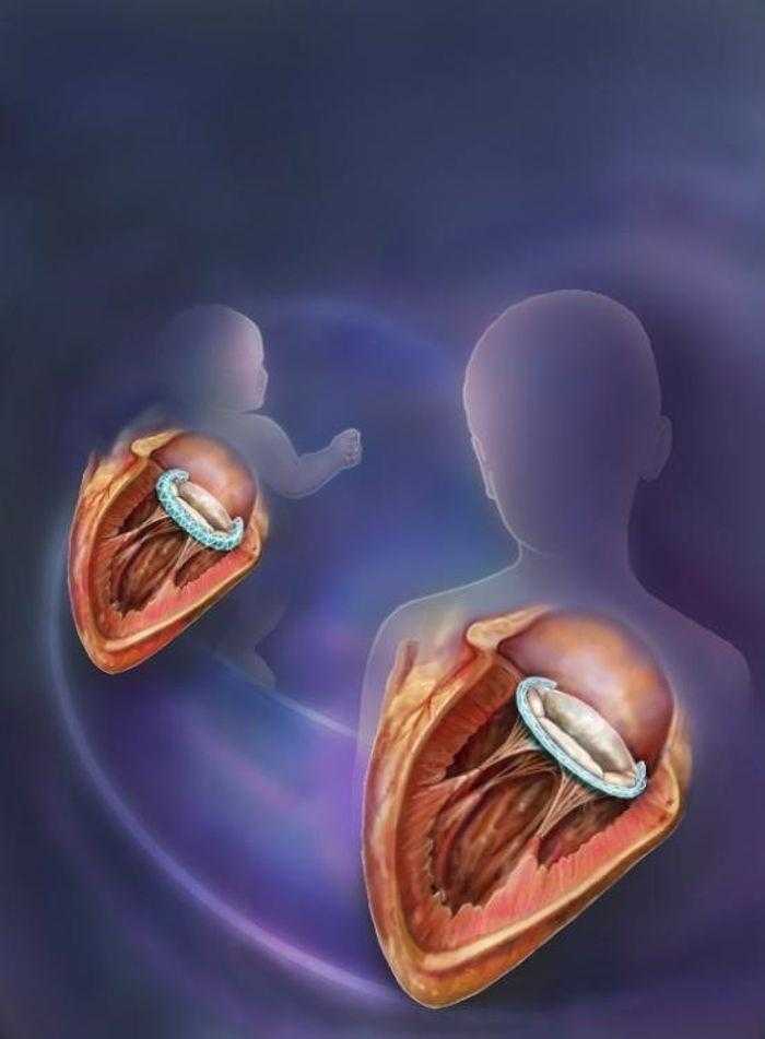 تطوير غرسات طبية medical implants قابلة للنمو لإصلاح عيوب الصمامات القلبية في الأطفال تطوير غرسات طبية medical implants قابلة للنمو لإصلاح عيوب الصمامات القلبية في الأطفال