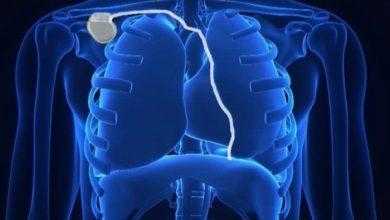 الغذاء والدواء توافق على جهاز جديد لعلاج انقطاع النفس النومي "sleep apnea"