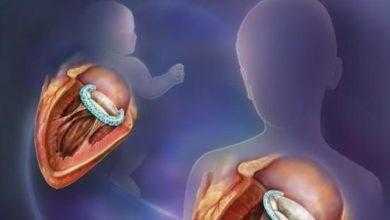 تطوير غرسات طبية "medical implants" قابلة للنمو لإصلاح عيوب الصمامات القلبية في الأطفال