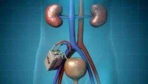 كلية اصطناعية بتكنولوجيا النانو بدلاً من غسيل الكلى في غضون 2-3 سنوات كلية اصطناعية بتكنولوجيا النانو بدلاً من غسيل الكلى في غضون 2-3 سنوات