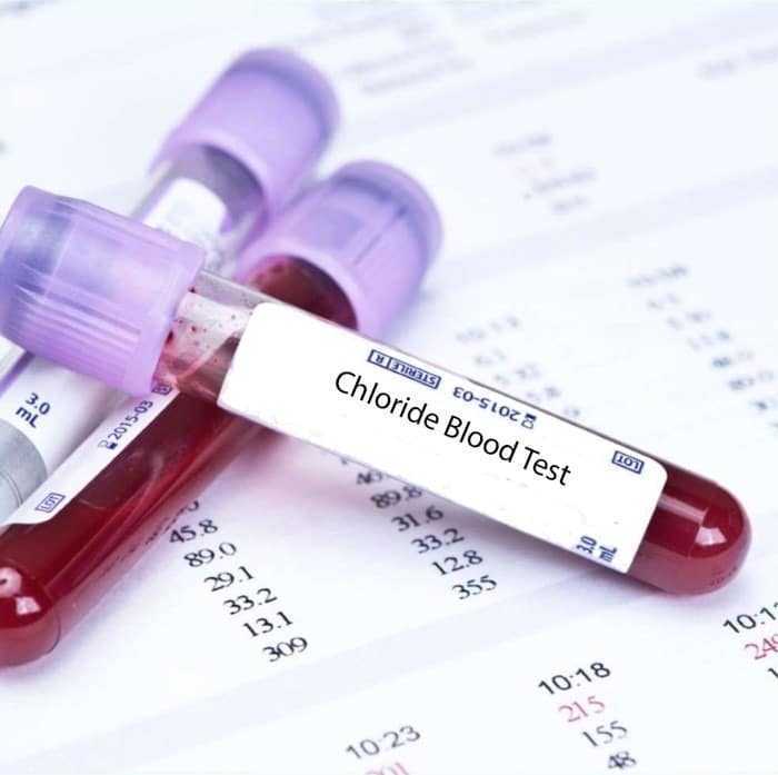 اختبار الكلوريد (Cl) في الدم