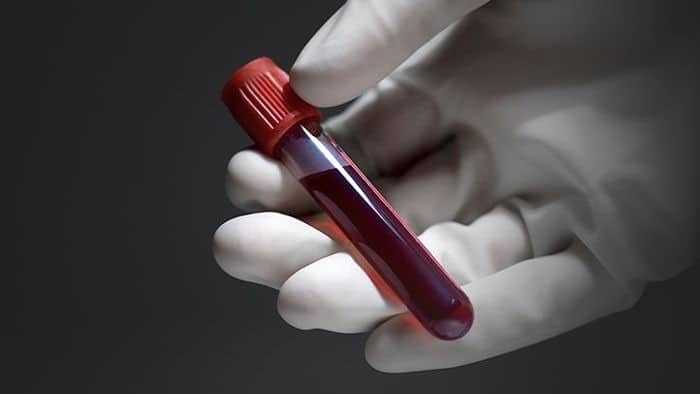 اختبار دم جديد للتنبؤ باحتمالية الإصابة بمرض الزهايمر