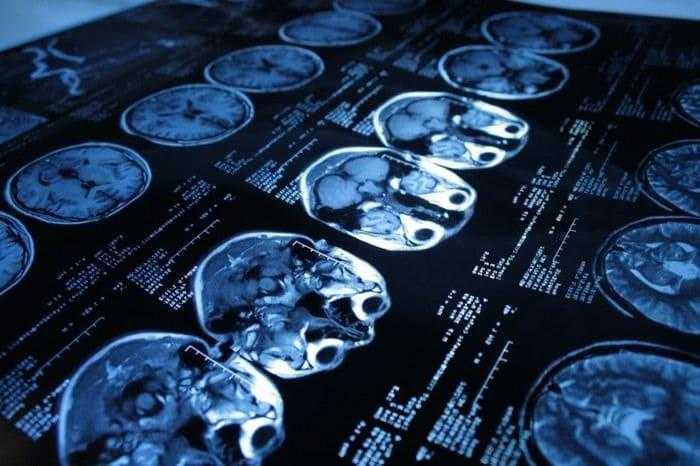 الغذاء والدواء توافق على أول اختبار من نوعه لتشخيص الارتجاج