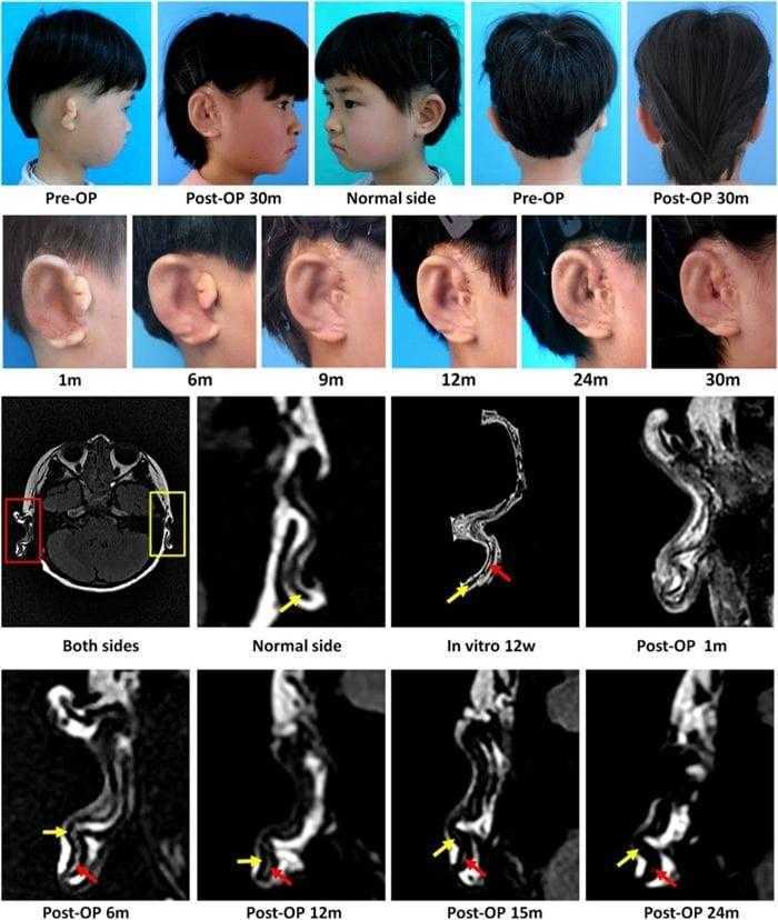 فريق بحثي صيني يتمكن من زراعة أذن جديدة لأول مرة