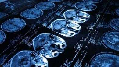 والدواء توافق على أول اختبار من نوعه لتشخيص الارتجاج