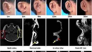بحثي صيني يتمكن من زراعة أذن جديدة لأول مرة