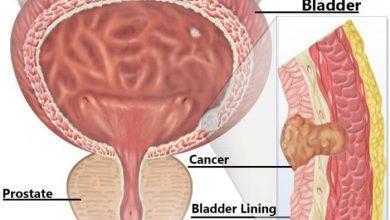 جديد للبول للكشف عن سرطان المثانة