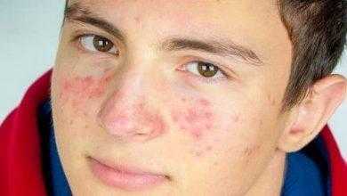 يعاني بعض الناس دون غيرهم من حبوب الشباب؟