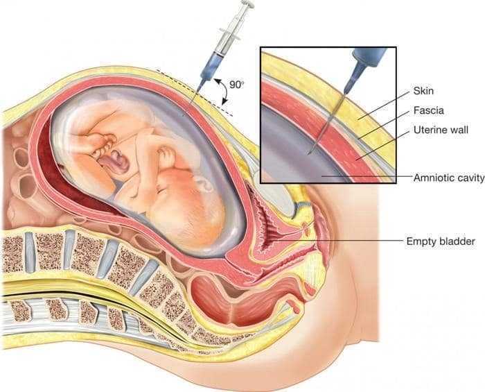 بزل السائل الأمنيوسي – Amniocentesis