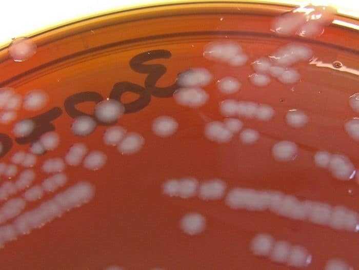 حالة من الهلع في الأوساط الطبية بعد الكشف عن مصاب بالسيلان