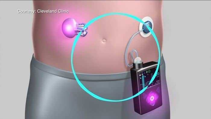 طفرة جديدة في أنظمة البنكرياس الاصطناعي طفرة جديدة في أنظمة البنكرياس الاصطناعي