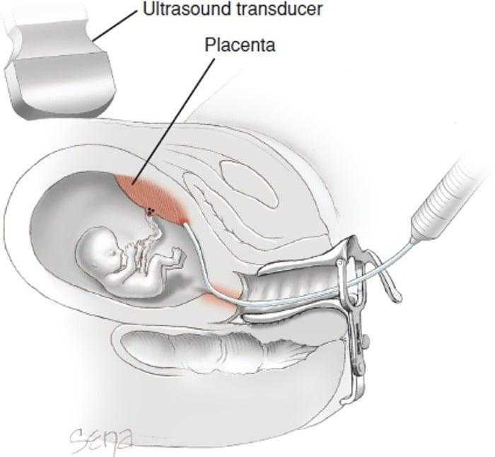 فحص الزغابات المشيمية - Chorionic Villus Sampling فحص الزغابات المشيمية - Chorionic Villus Sampling