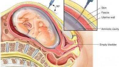 السائل الأمنيوسي – Amniocentesis