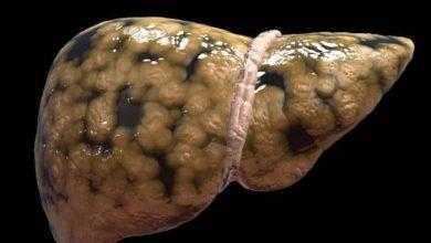 المبايض يضاعف خطر الإصابة بأمراض الكبد