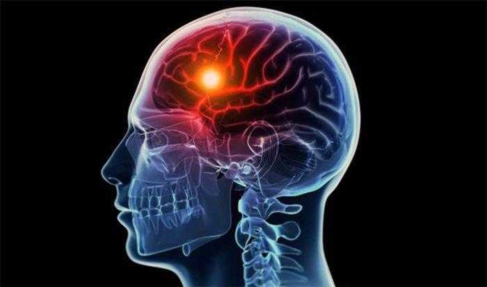 مصاب السكتة الدماغية يتمكن من الحركة مجددًا بعد حقنه بالخلايا الجذعية