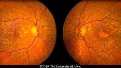 التجارب السريرية الأولية لعلاج أمراض الشبكية باستخدام الخلايا الجذعية